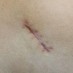 Keloid Scars