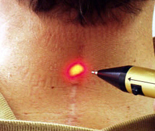 Laser Treatment