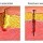 Puncture Wounds Scars