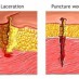 Puncture Wounds Scars